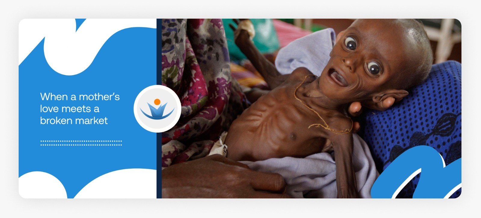 A severely malnourished child lying on a hospital bed with visible ribs and bones, illustrating the heartbreaking reality for malnourished children in Africa in 2026.